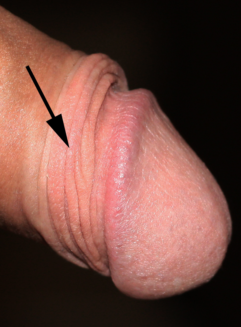 Penis Foreskin Pain TubeZZZ