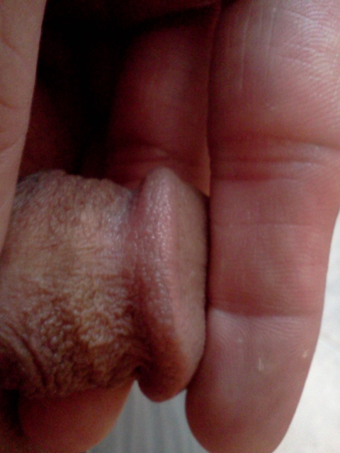 Penis Foreskin Pain TubeZZZ Porn P