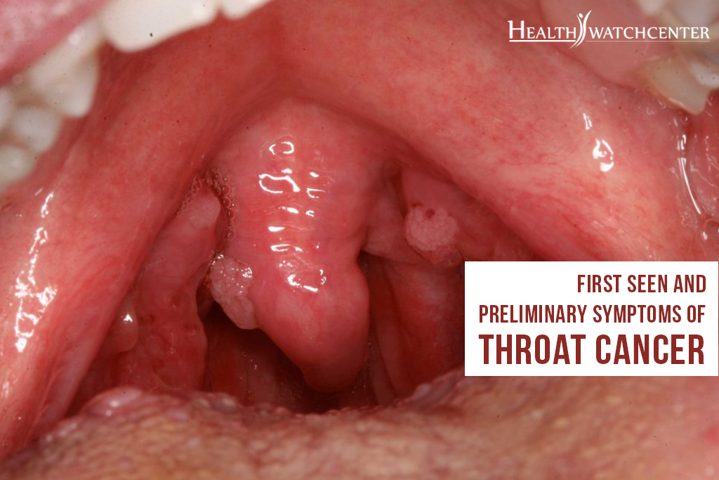 Carcinoma of the throat | TubeZZZ Porn Photos