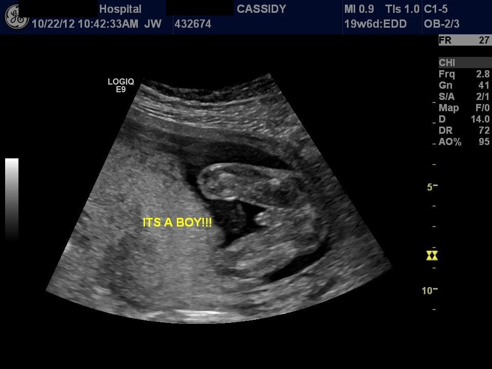 Ultrasound Sex Porn - Pregnancy ultrasound boy or girl | TubeZZZ Porn Photos