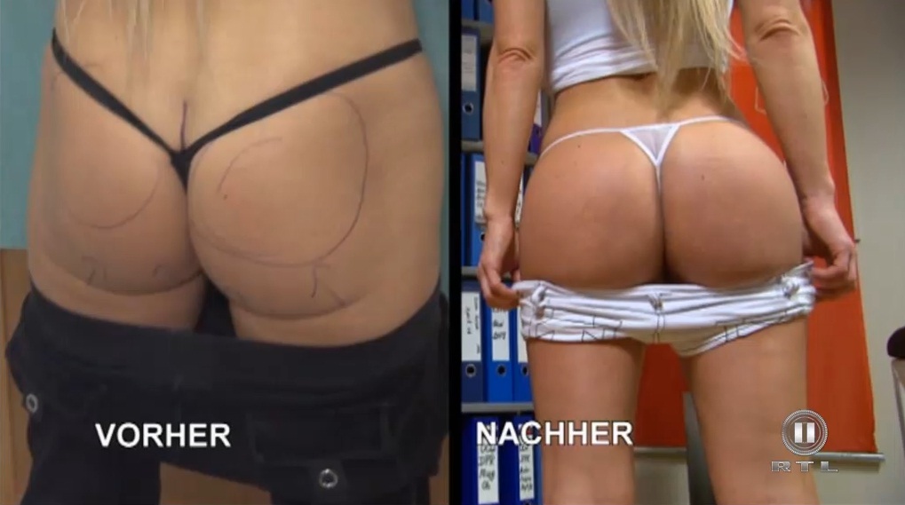 Ass Implants Before And After TubeZZZ Porn Photos