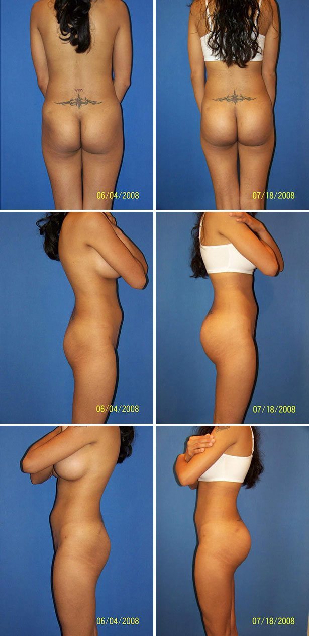 Ass Implants Before And Afte