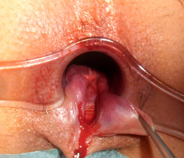 Anal Tearing From - Anal Tear Porn | Sex Pictures Pass