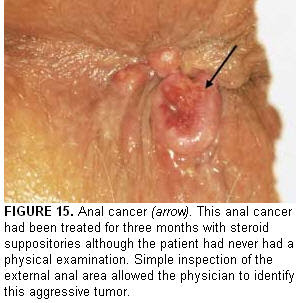 Anal Lump - Anal cancer versus colon cancer | TubeZZZ Porn Photos