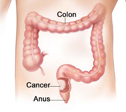 530px x 470px - Anal cancer versus colon cancer | TubeZZZ Porn Photos