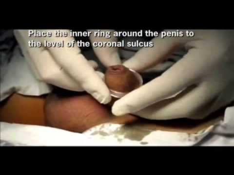 480px x 360px - Circumcision for adult males | TubeZZZ Porn Photos